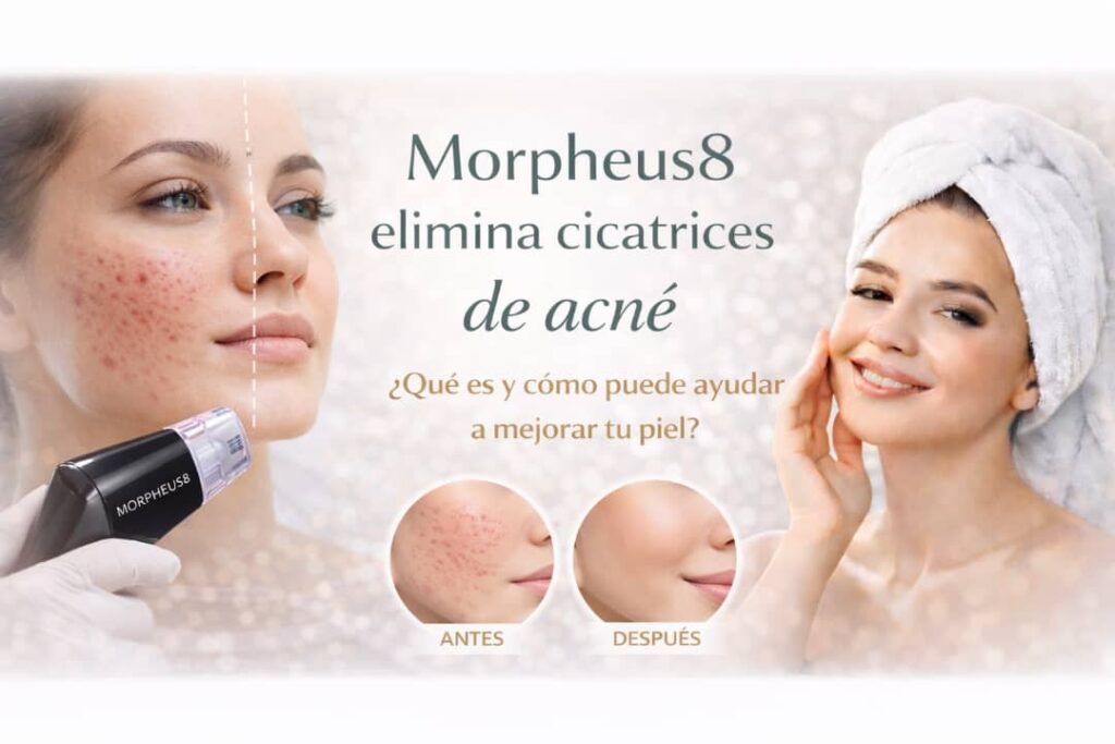 Tratamiento con Morpheus 8 en Waydimar Sthetic Solution para eliminar cicatrices de acné y renovar la textura de la piel