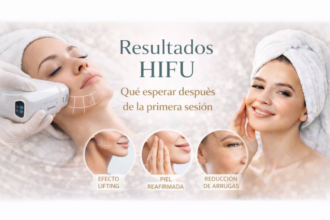 ¿Cuántas sesiones de HIFU se necesitan para ver resultados?