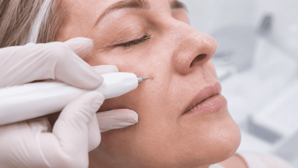 Profesional realizando un procedimiento con Plasma Pen sobre una pequeña lesión cutánea en el rostro