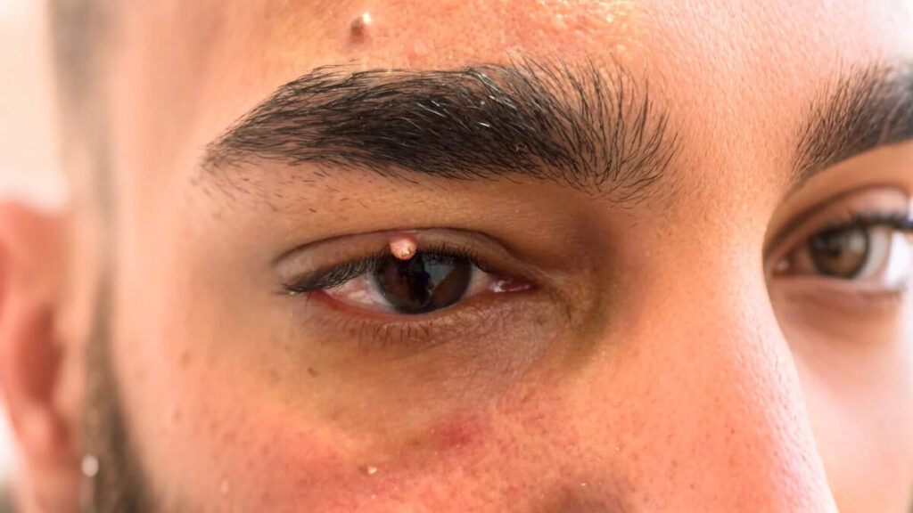 Primer plano de un paciente con un acrocordón en el borde del párpado antes del tratamiento en Waydimar Sthetic Solution Vega Alta.