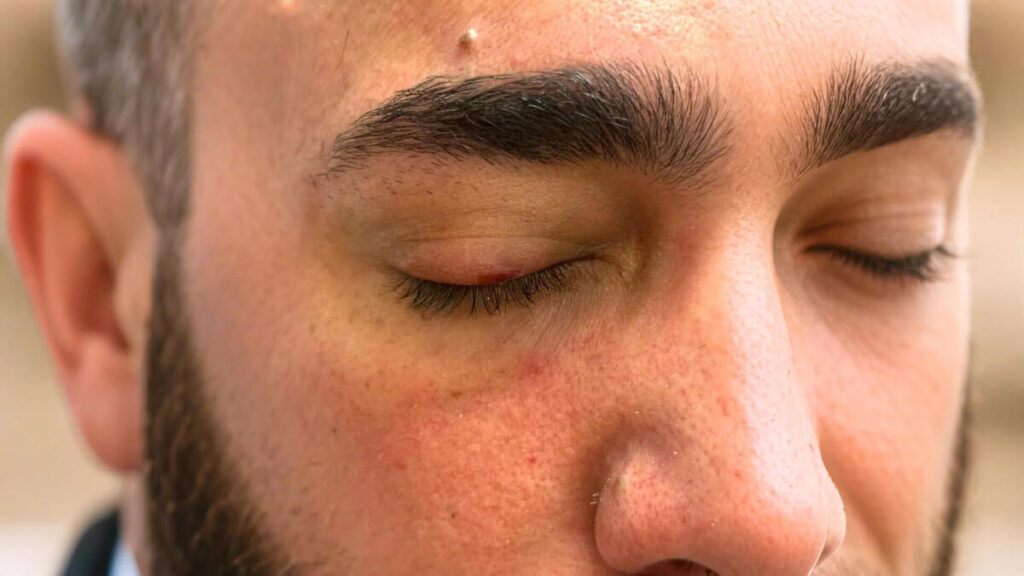 > Primer plano de un párpado con un pequeño acrocordón cutáneo antes del tratamiento estético en Waydimar Sthetic Solution Vega Alta.