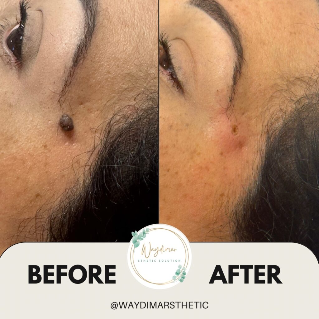 Remoción de verruga facial antes y después en Waydimar Sthetic Solution, tratamiento estético en Vega Alta, Puerto Rico.