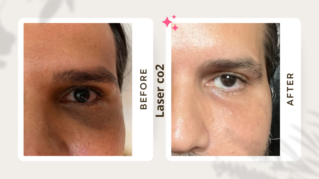 Resultado real del tratamiento con láser CO₂ en ojeras y textura en paciente masculino de Waydimar Sthetic Solution.