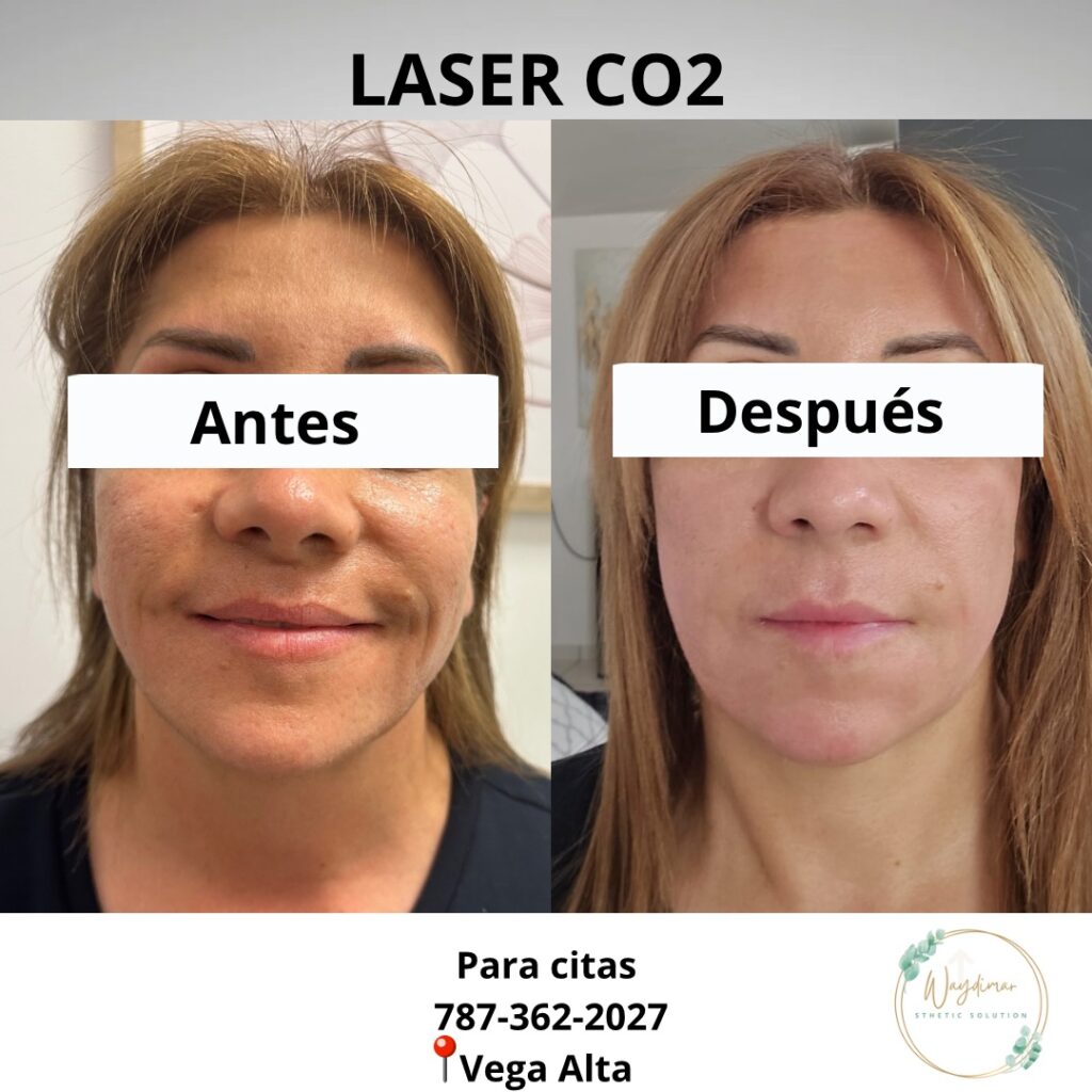 Resultado real de tratamiento con láser CO₂ en Waydimar Sthetic Solution, mostrando comparación antes y después en paciente femenina.