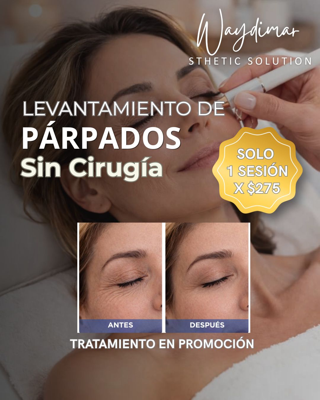 Tratamiento estético para mejorar la apariencia de párpados caídos y mirada cansada sin cirugía.