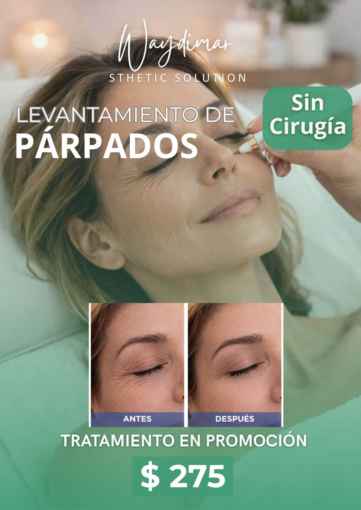 Procedimiento de levantamiento de párpados sin cirugía en Vega Alta Waydimar Sthetic