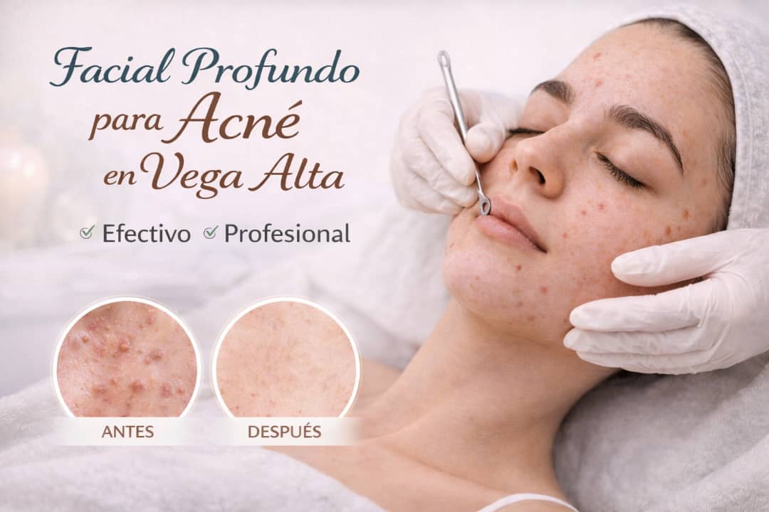 Facial Profundo para Acné en Vega Alta: Limpieza Profesional para una piel sin impurezas