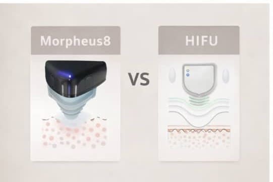 Comparación entre Morpheus8 y HIFU para rejuvenecimiento facial sin cirugía.