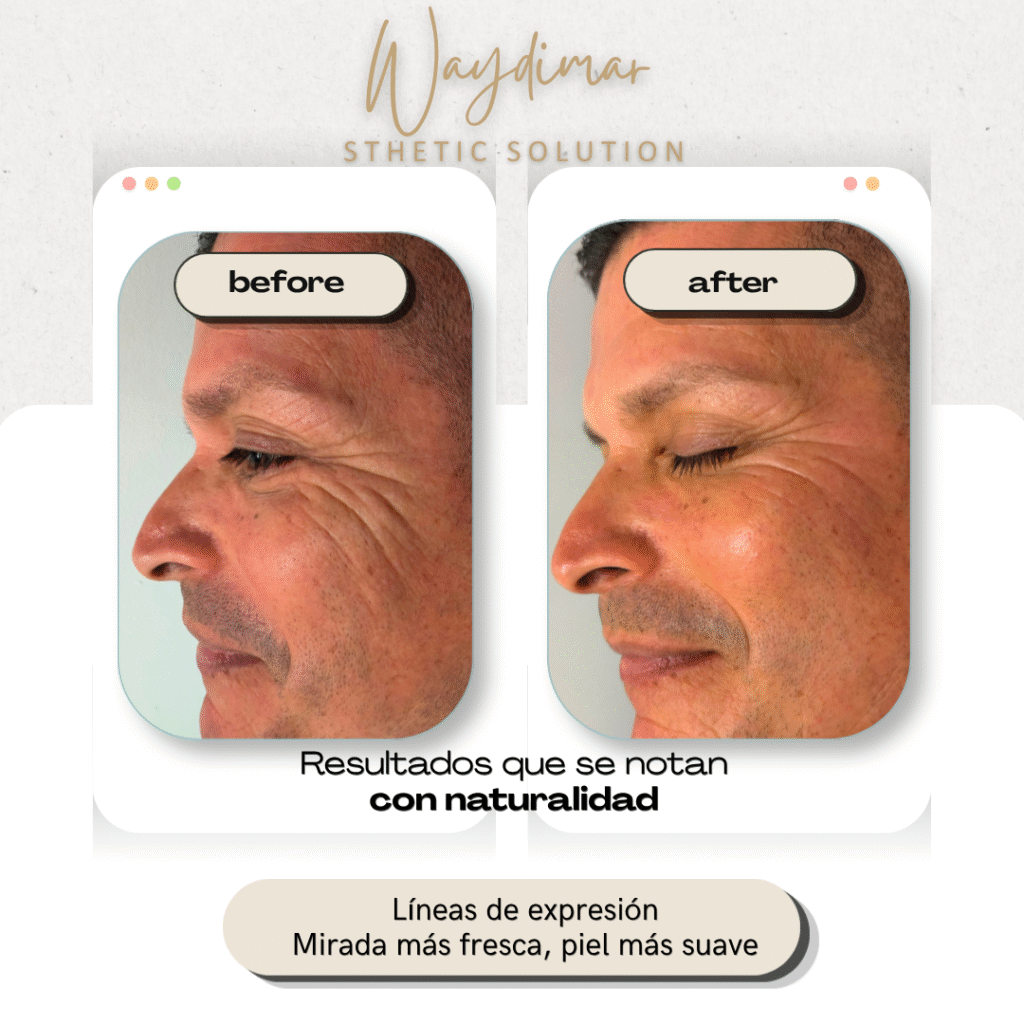 Antes y después de tratamiento para líneas de expresión en Waydimar Sthetic Solution Vega Alta