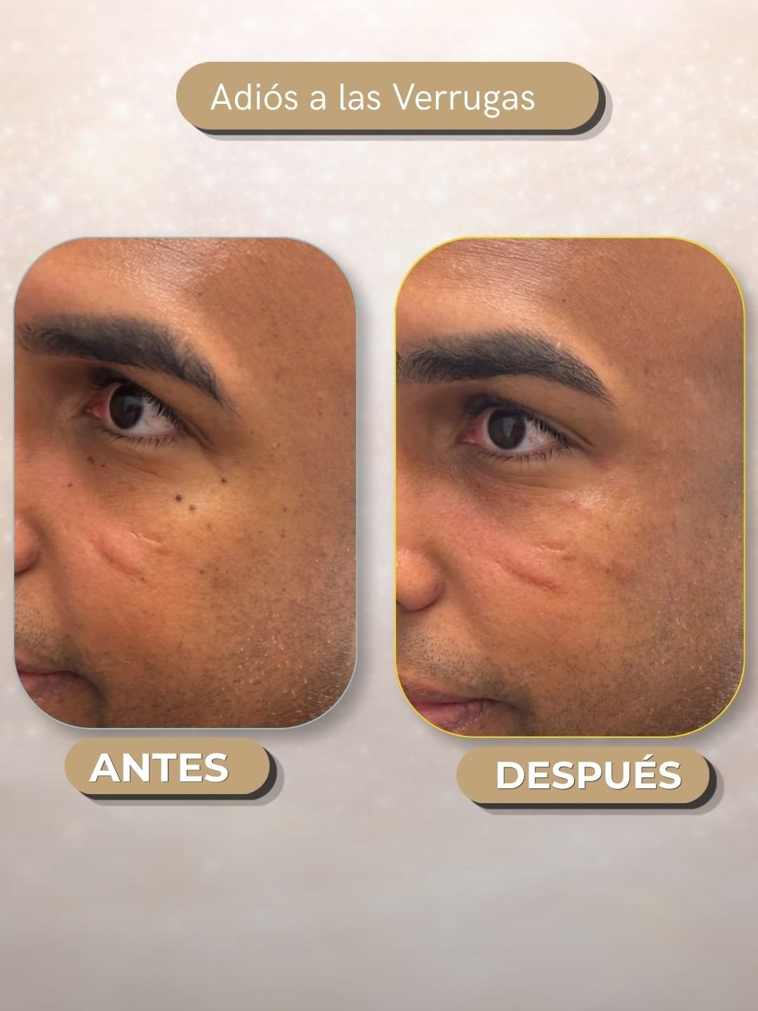 omparativa de antes y después de un hombre tras un tratamiento para eliminar verrugas en la zona de la ojera y el pómulo.