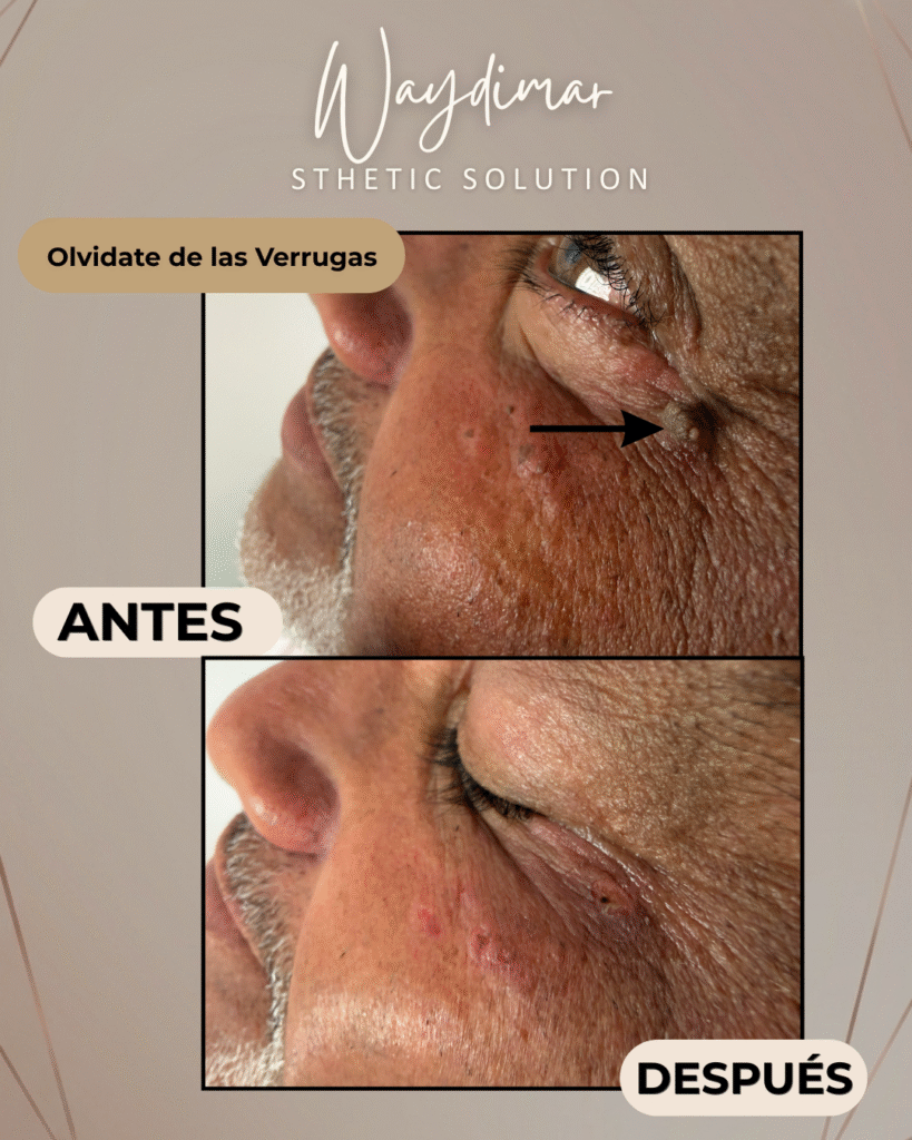 Una imagen de primer plano de la piel periocular (cerca del párpado) de un hombre, mostrando la remoción de una verruga. La parte superior muestra la verruga original indicada por una flecha. La parte inferior muestra el párpado y la mejilla sin la verruga, con solo pequeñas marcas de curación visibles, ilustrando la piel más tensa y suave de la zona tras el procedimiento de Waydimar Sthetic Solution.