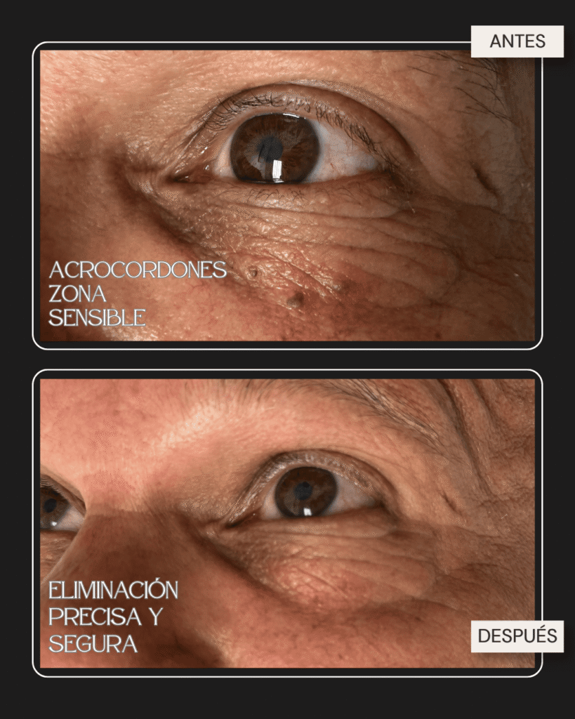 Antes y después de remoción de acrocordones en zona sensible cerca del ojo en Vega Alta