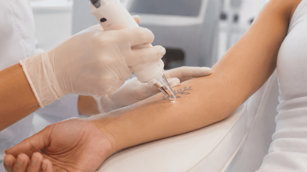 cómo funciona la remoción de tatuajes con láser