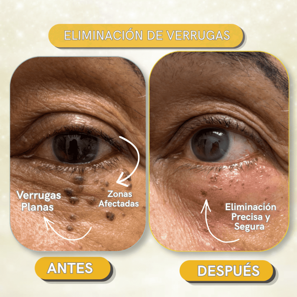 antes y después de remoción de verrugas plana en zona periocular en Vega Alta