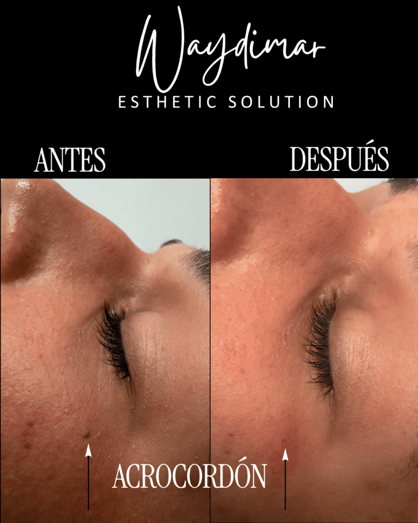 remocion de acrocordones antes y despues